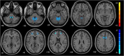 Disruption of Cerebellar–Cerebral Functional Connectivity in Temporal Lobe Epilepsy and the Connection to Language and Cognitive Functions